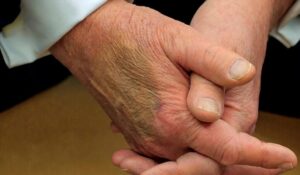 President Trump Explains In Detail Why His Hands Are Bruising